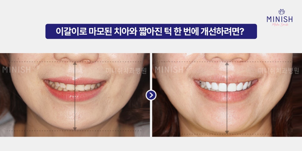 Bruxism and TMJ: If Left Untreated, Both Your Teeth and Joints Could Be at Risk image 7