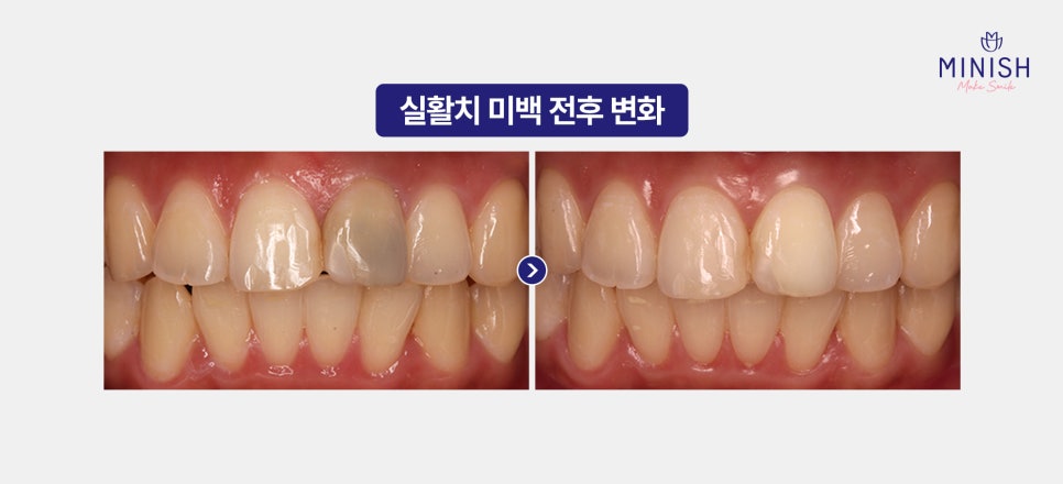 Yellow Teeth Concerns: Teeth Whitening Methods That Vary by Cause image 12