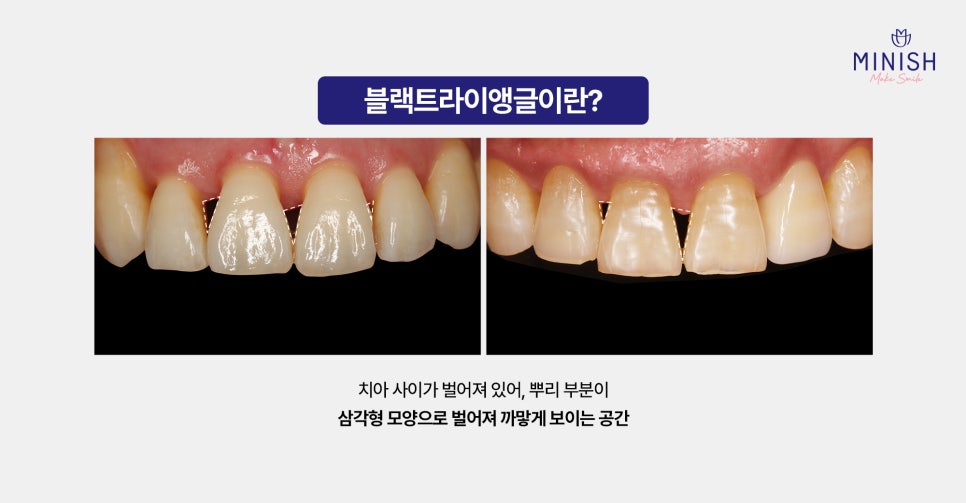 블랙트라이앵글 원인과 레진, 미니쉬 해결 방법 관련 이미지 2