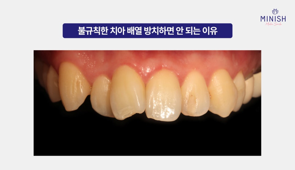 Worried About Orthodontics? Improve in One Day with Minish Harmony! image 2