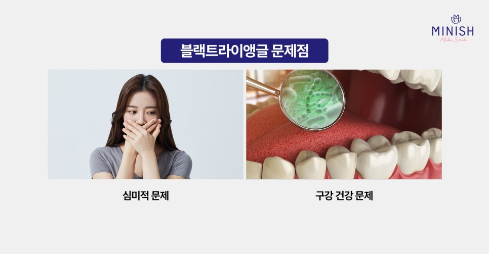 블랙트라이앵글 원인과 레진, 미니쉬 해결 방법 관련 이미지 4