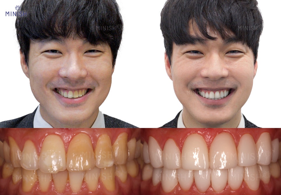 강남구청역치과 누런이, 누런치아 때문에 스트레스라면?! 관련 이미지 3