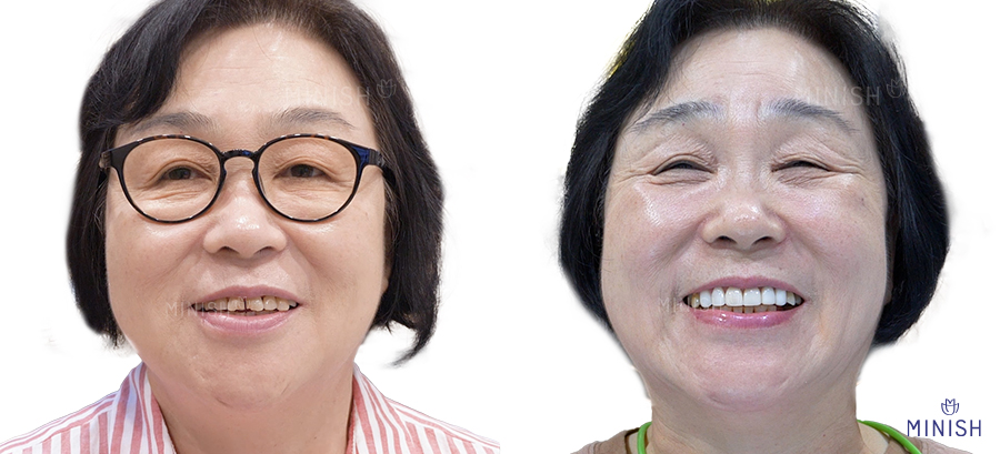 치아성형 고민? 미니쉬치과 병원에서 해결! 관련 이미지 3