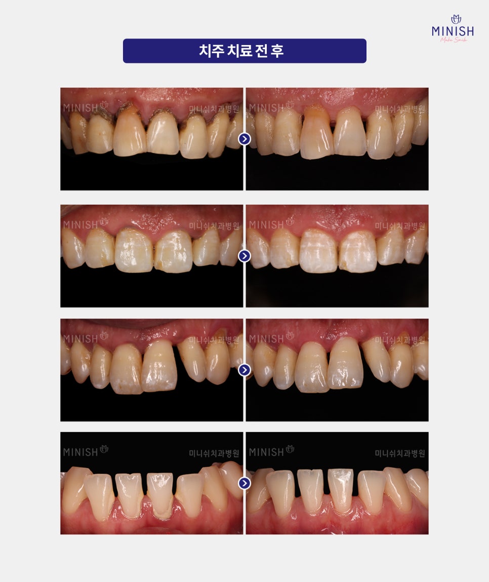 If Gum Swelling Continues, Suspect Periodontal Disease image 6