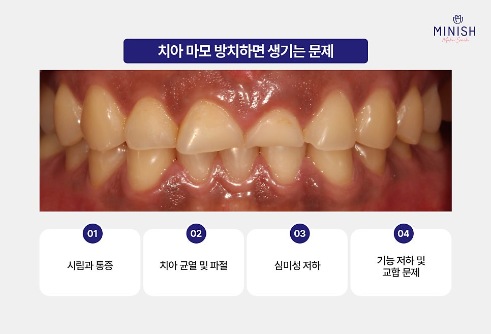 If You Leave Tooth Wear Untreated, It Becomes Irreversible. What Is the Solution? image 3
