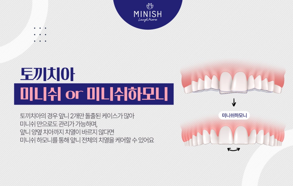 도드라지는 토끼치아 콤플렉스 미니쉬치과병원에서 앞니교정으로! 관련 이미지 5