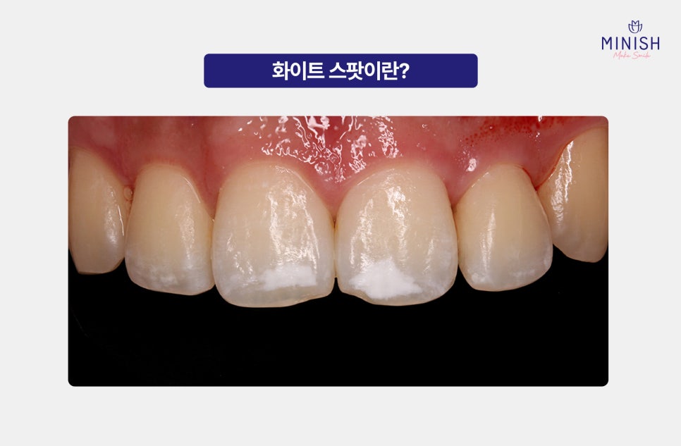 White Spots on Teeth: Worried About White Stains on Your Teeth? Here’s How to Improve Them Healthily! image 2