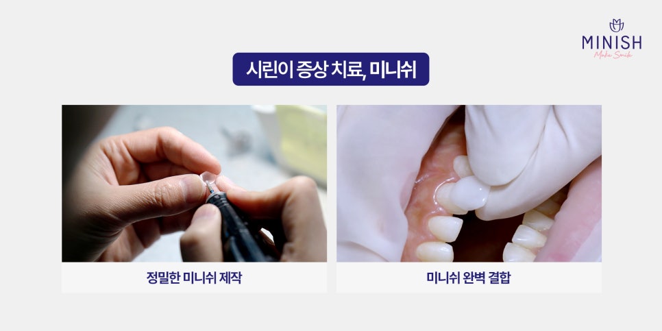 시린이 치료로 주목받는 미니쉬! 관련 이미지 5