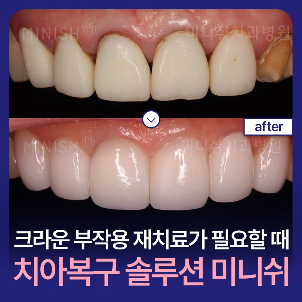 When Crown Retreatment Is Needed: The Tooth Restoration Solution Minish image 1