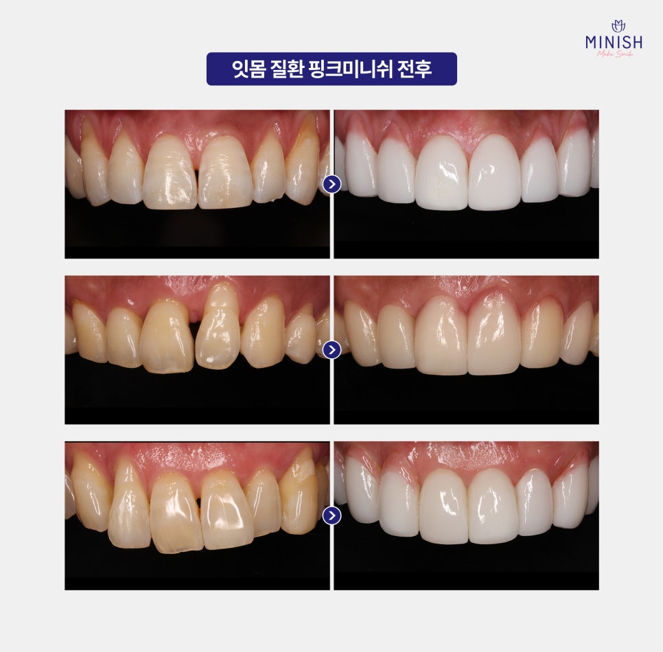 If You Miss the Warning Signs of Gum Disease, It Becomes Hard to Reverse. What Is the Right Treatment Method? image 5