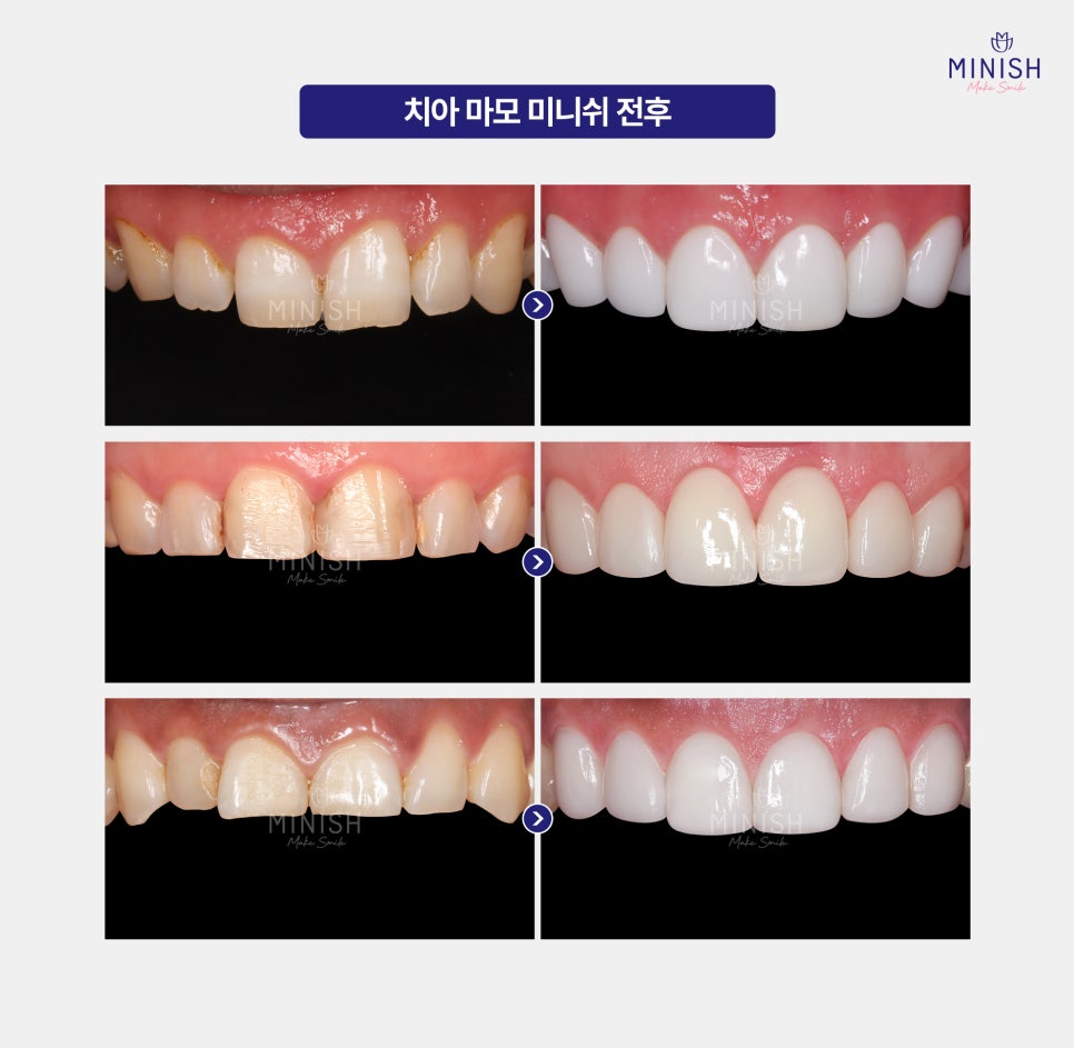 Pain Caused by Tooth Wear: From the Root Causes to Recovery Methods image 5