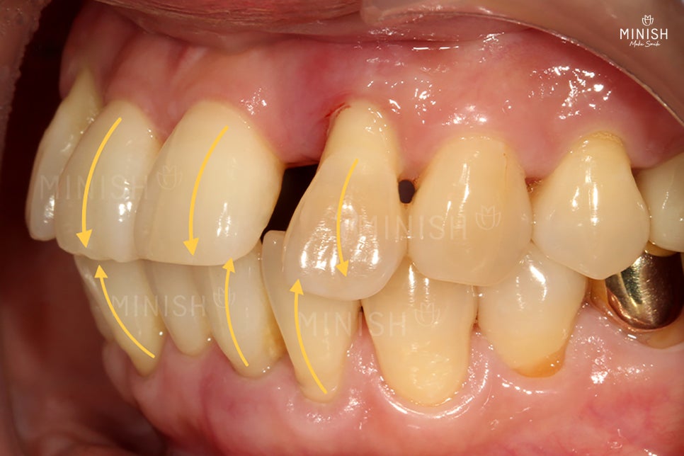 Are you wondering how to restore gums damaged by gum disease? image 4
