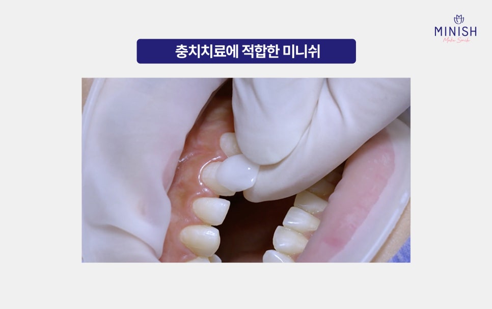 Key Points to Check Before Proceeding with Cavity Treatment Using Resin image 4
