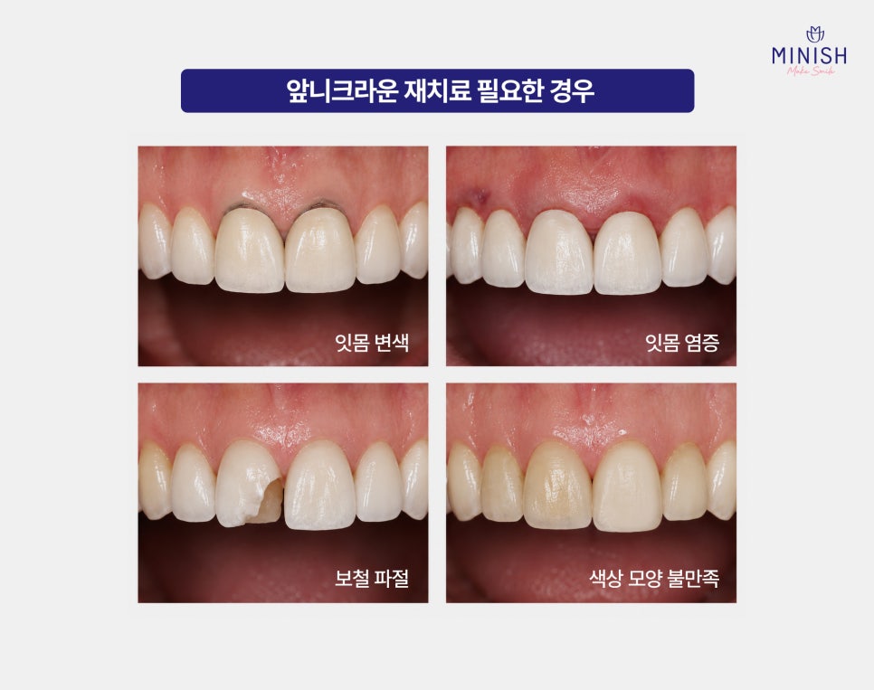 Should a Discolored Front Tooth Crown Be Replaced? Minish Revive for Retreatment image 3