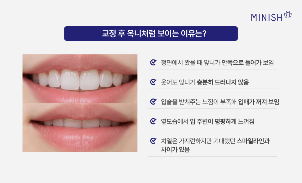 교정 후 들어간 입, 옥니 (옹니)가 고민, 미니쉬로 개선할 수 있을까? 관련 이미지 3