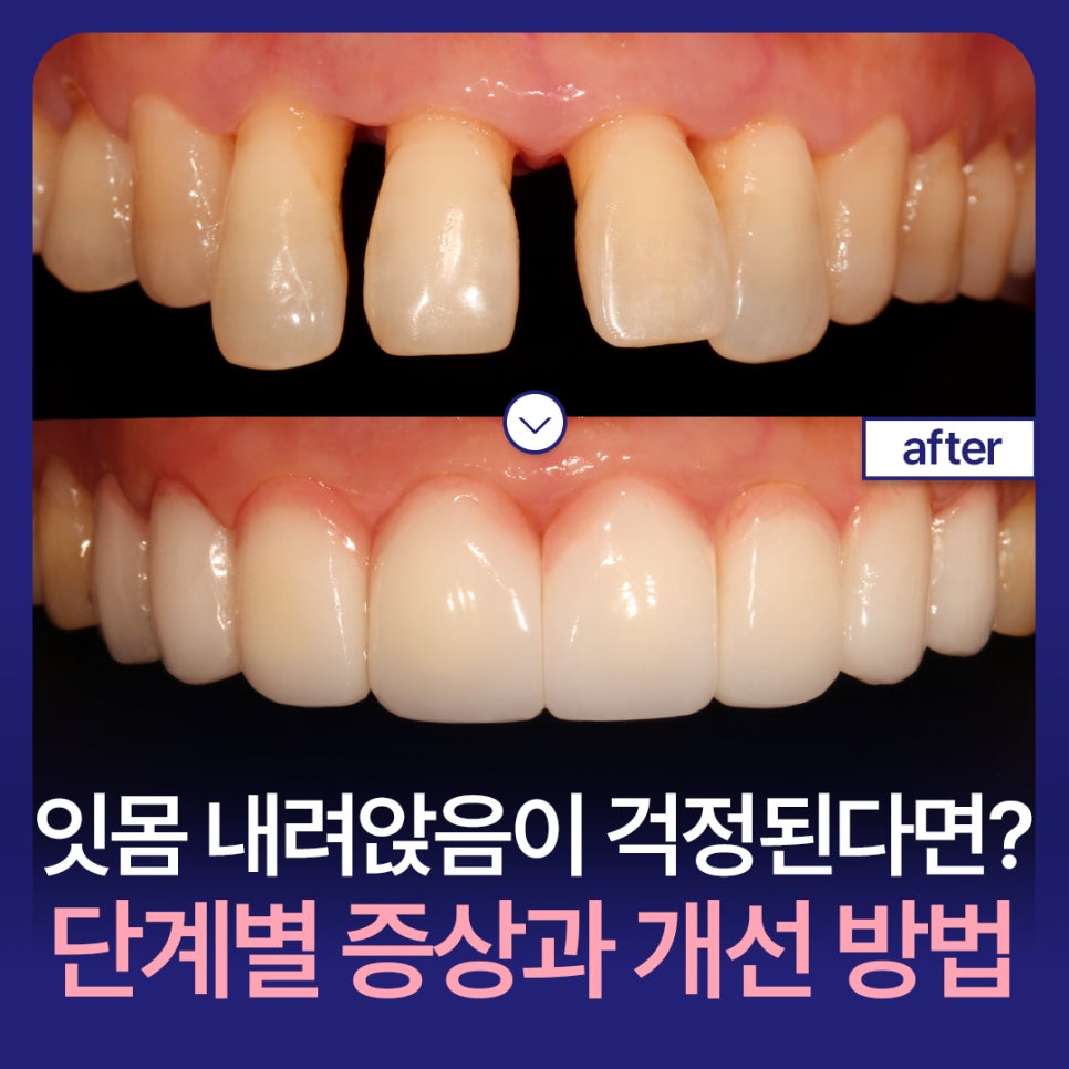 Worried About Gum Recession? Symptoms by Stage and Ways to Improve It image 1