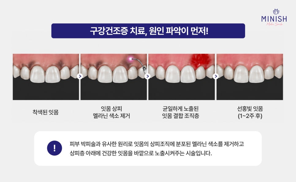 잇몸이 까매요 잇몸미백 필요한 경우 알아보기 관련 이미지 3