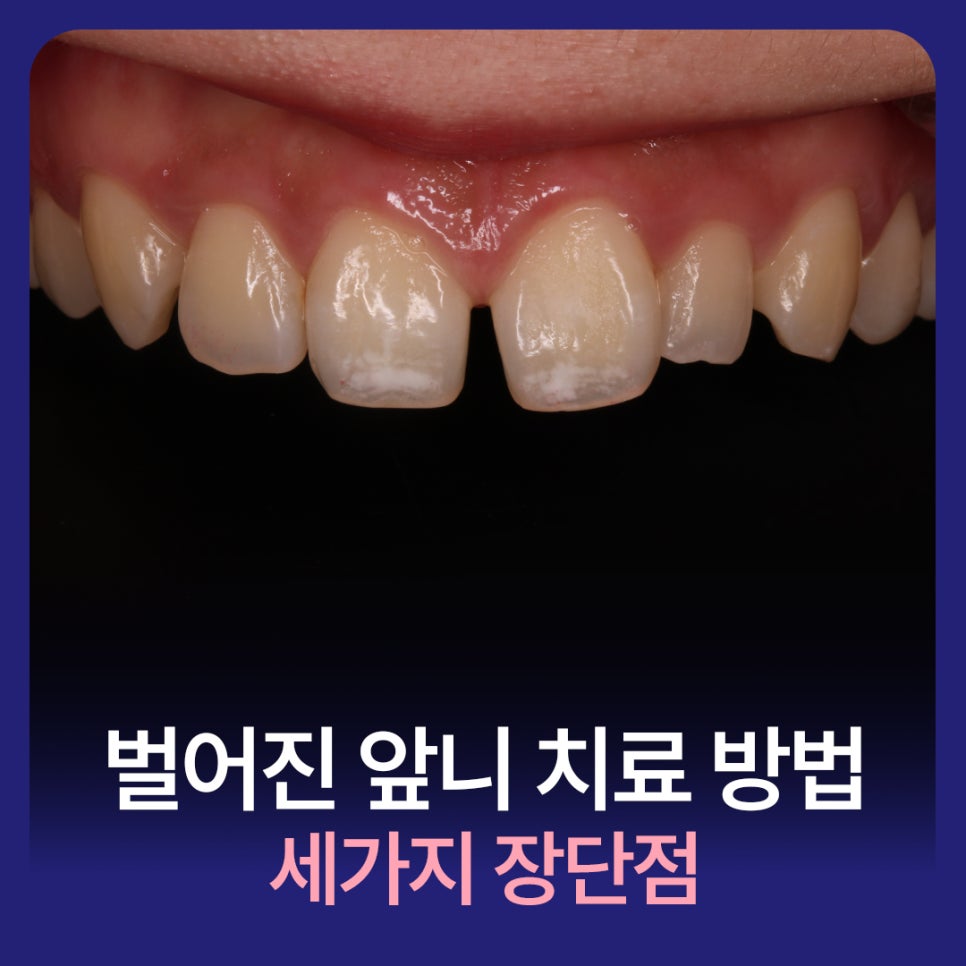 벌어진 앞니 치료 방법 세가지 장단점 관련 이미지 1
