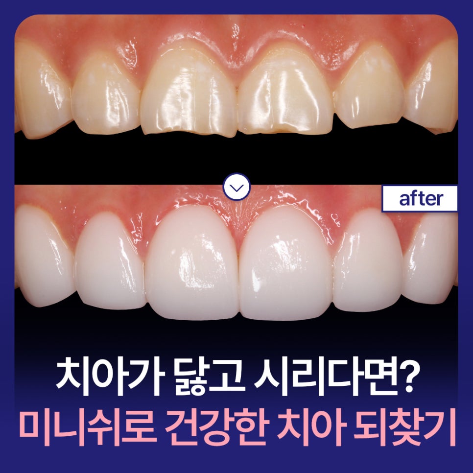 [Tooth Anti-Aging] If your teeth are worn down and sensitive, can Minish help you regain healthy teeth? image 1