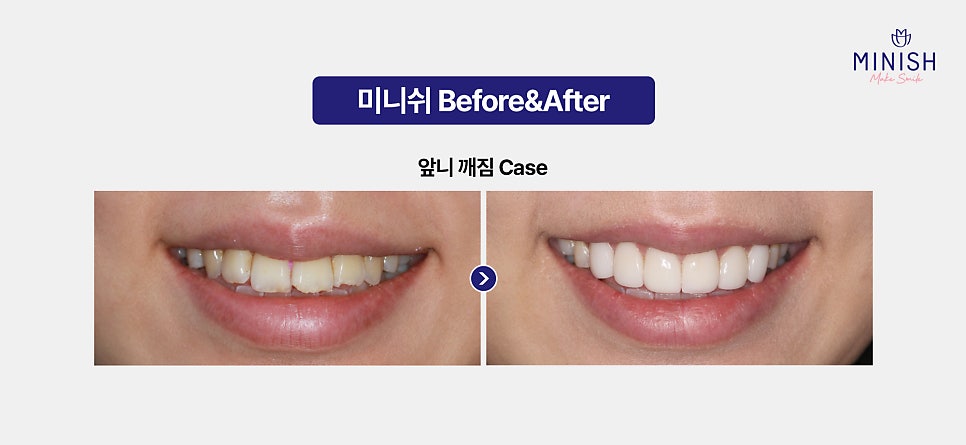 앞니깨짐 레진 치료의 한계와 치아복구솔루션 미니쉬 특장점 관련 이미지 5