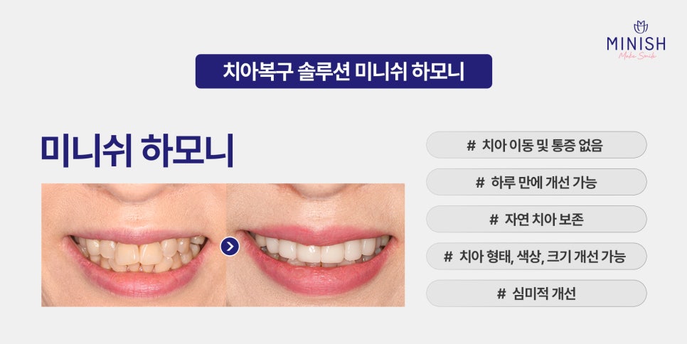 Complex About Crooked Canines? Improve Quickly Without Orthodontics with Minishe Harmony! image 4