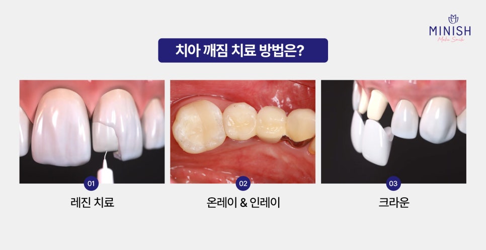 A chipped tooth: the fact that there is a way to restore it like a natural tooth! image 3