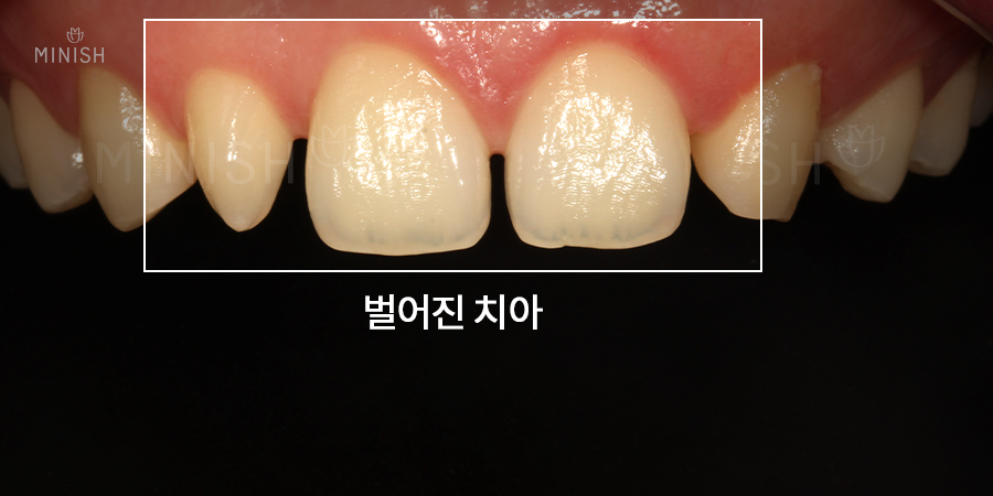 치아벌어짐 고민하지 말고 원데이미니쉬로 빠르게 관련 이미지 2
