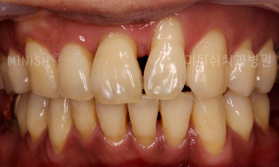 치주염, 건강함과 심미성 모두 만족하는 치료는? 관련 이미지 4