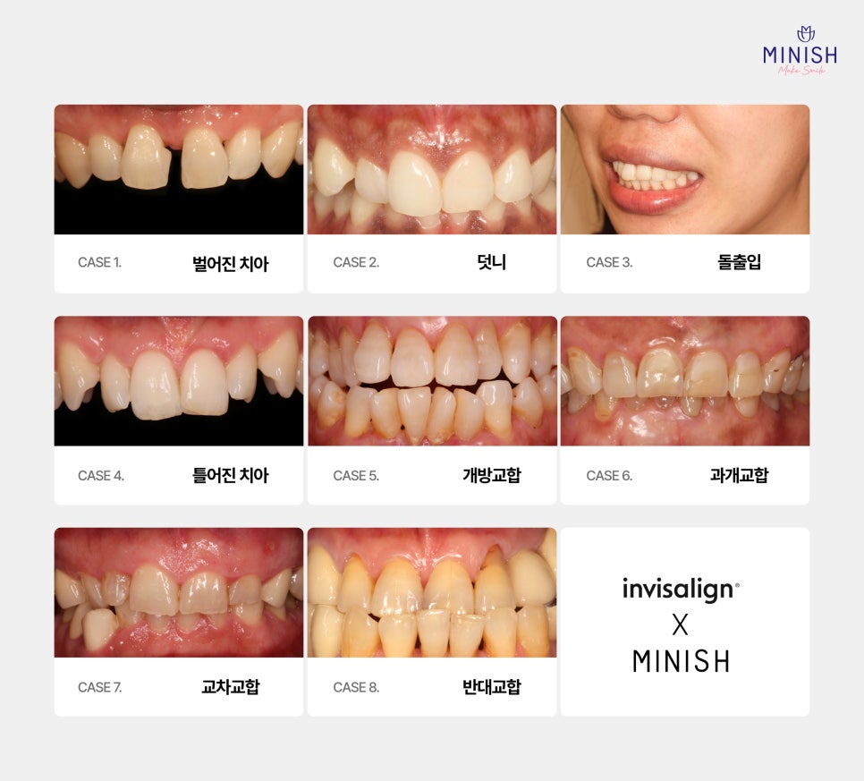 잘 보이지 않는 투명교정 하기 전에 알아두면 좋은 점 관련 이미지 4