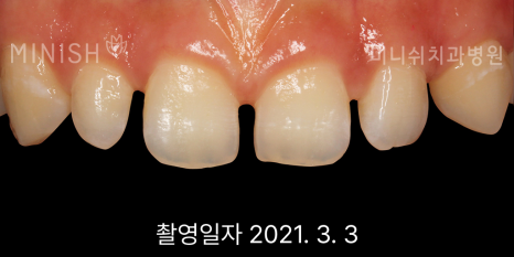 벌어진 앞니 치료 방법 세가지 장단점 관련 이미지 7