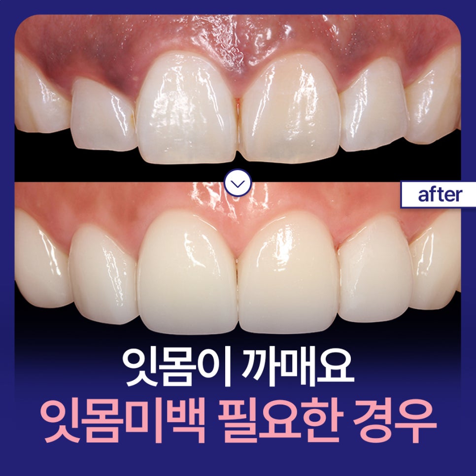 잇몸이 까매요 잇몸미백 필요한 경우 알아보기 관련 이미지 1