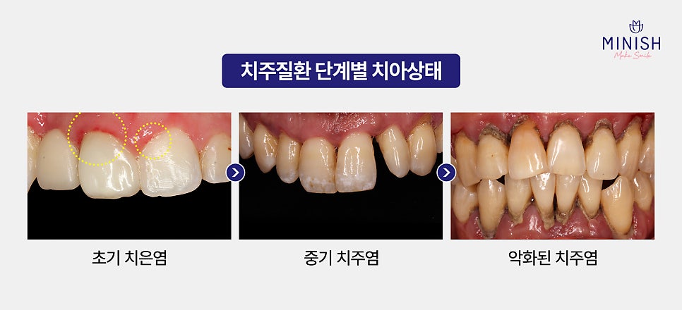 Bad Breath Causes: Could They Be More Serious Than You Think? A Summary of Solutions! image 4