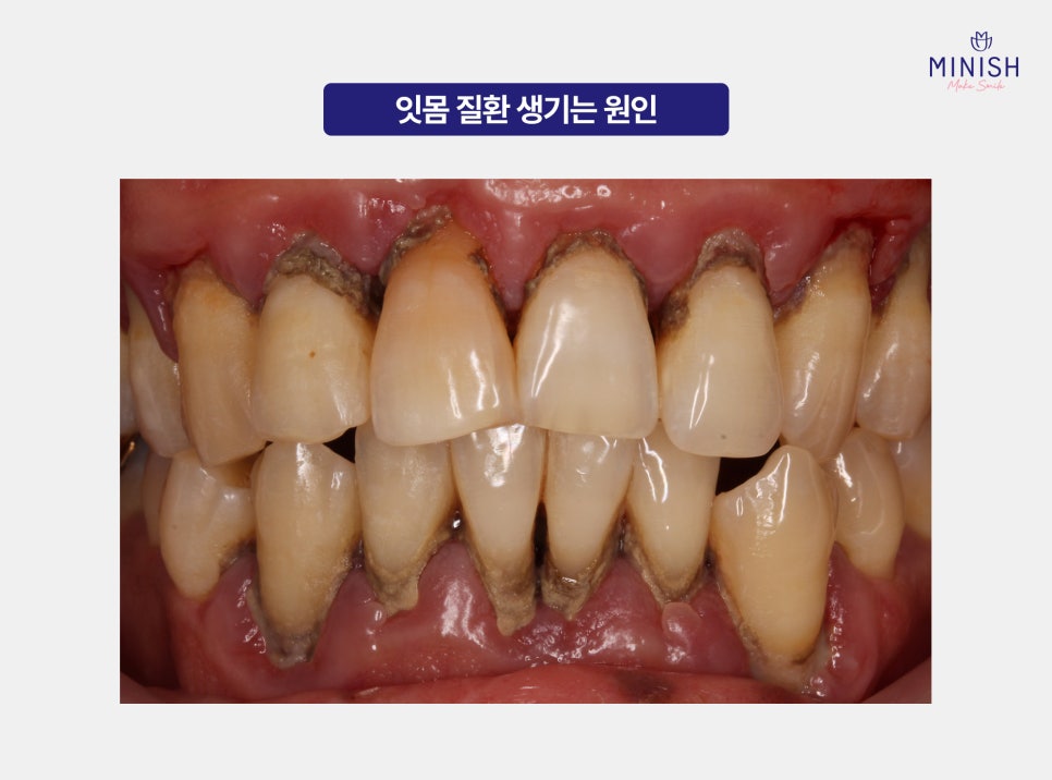 Gum Disease: Is It Just a Simple Problem? From Its Causes to Ways to Restore It image 2