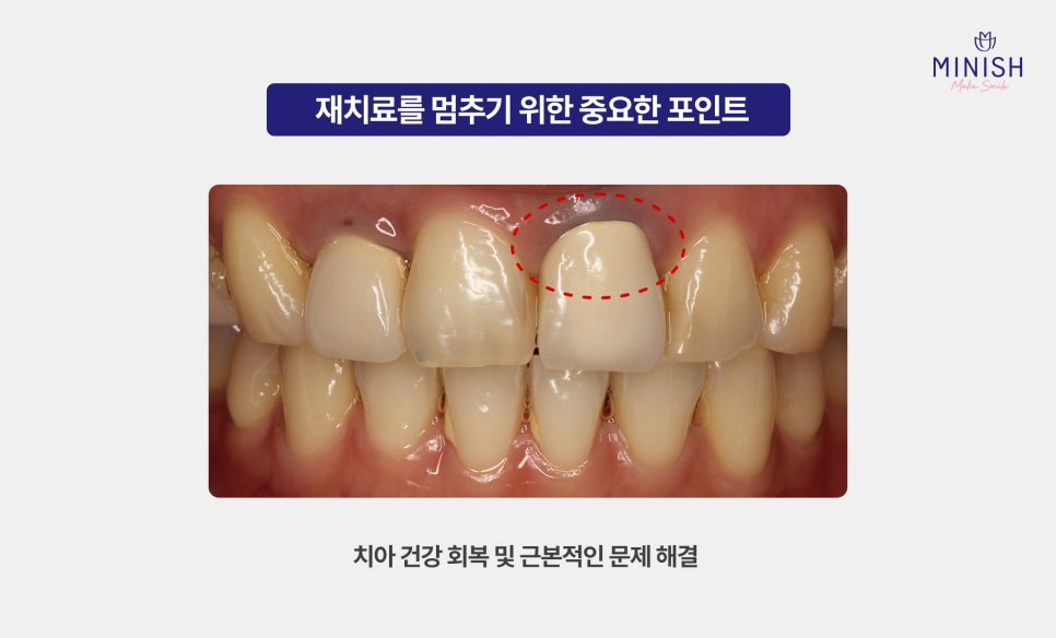 Why Do Veneers Keep Needing Retreatment? And How to Restore Them in a Healthy Way image 3