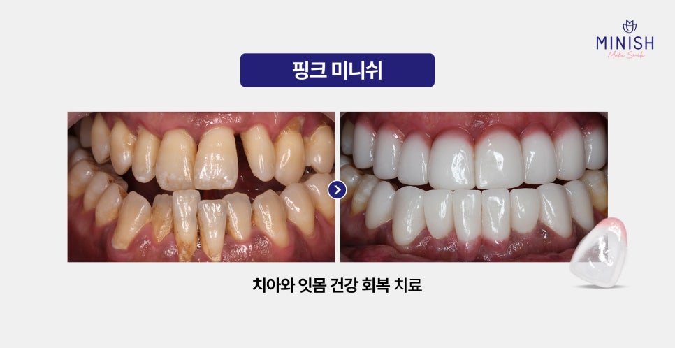 Worried About Gum Recession? Symptoms by Stage and Ways to Improve It image 4