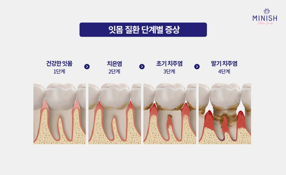 If You Miss the Warning Signs of Gum Disease, It Becomes Hard to Reverse. What Is the Right Treatment Method? image 3