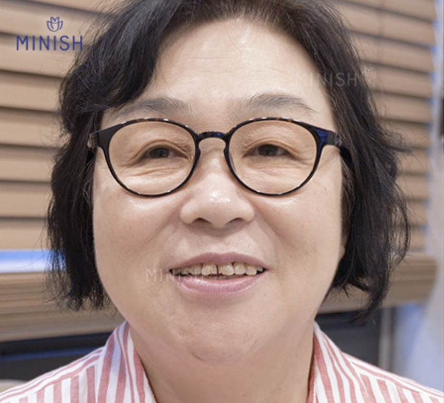 부모님 치아 노화, 변색 고민? 미니쉬 가격 고민 끝! 관련 이미지 3