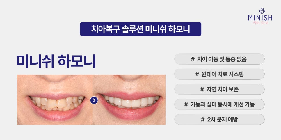 If You Want to Improve Irregular Teeth in Just One Day Without Orthodontics image 4
