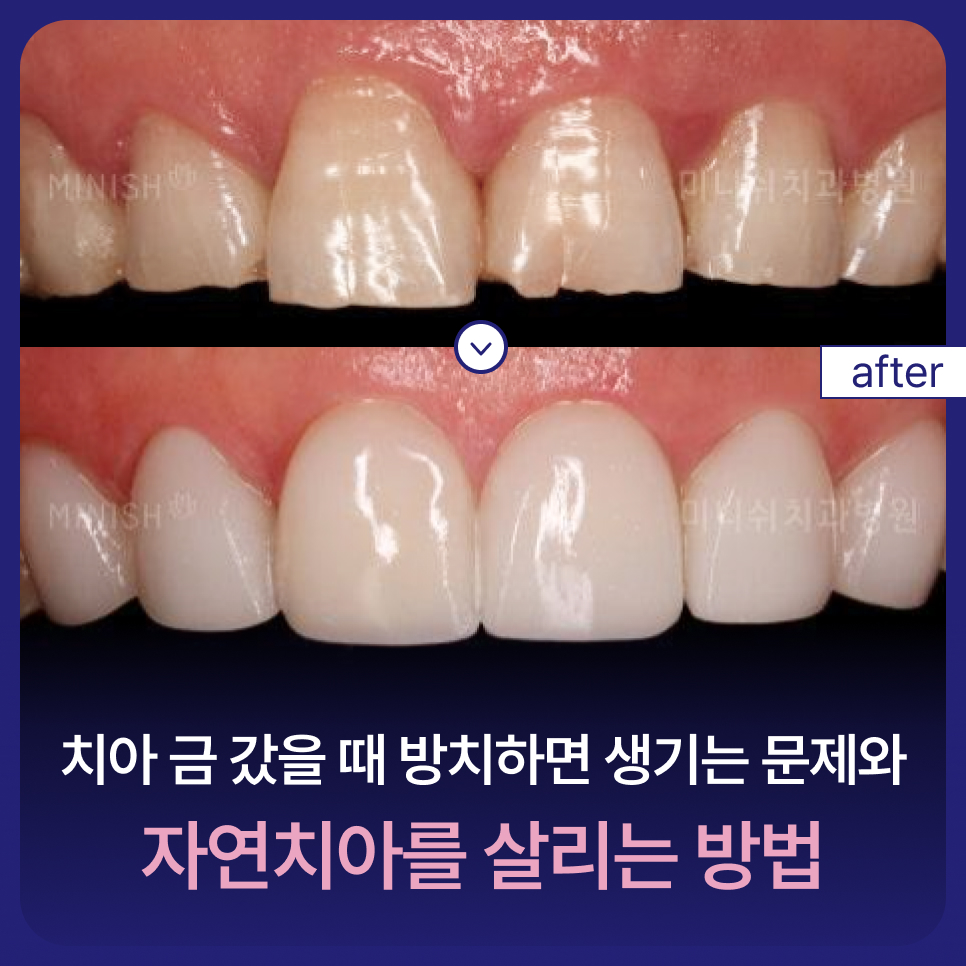 Problems That Can Occur If a Cracked Tooth Is Left Untreated and Ways to Preserve Natural Teeth image 1