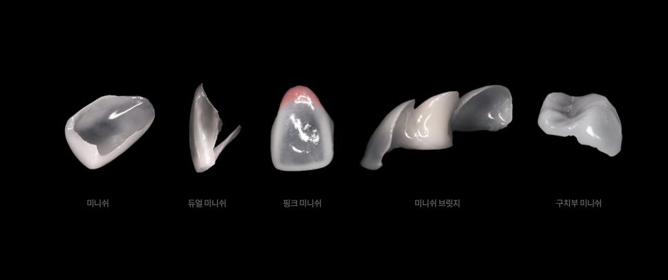 틀어진 앞니 하루만에 해결! (미니쉬, 라미네이트, 부분교정) 관련 이미지 2
