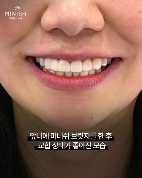 If Your Teeth Have Worn Down and Even Changed Your Face, Can They Be Restored? A Case Repaired with Minishe image 4
