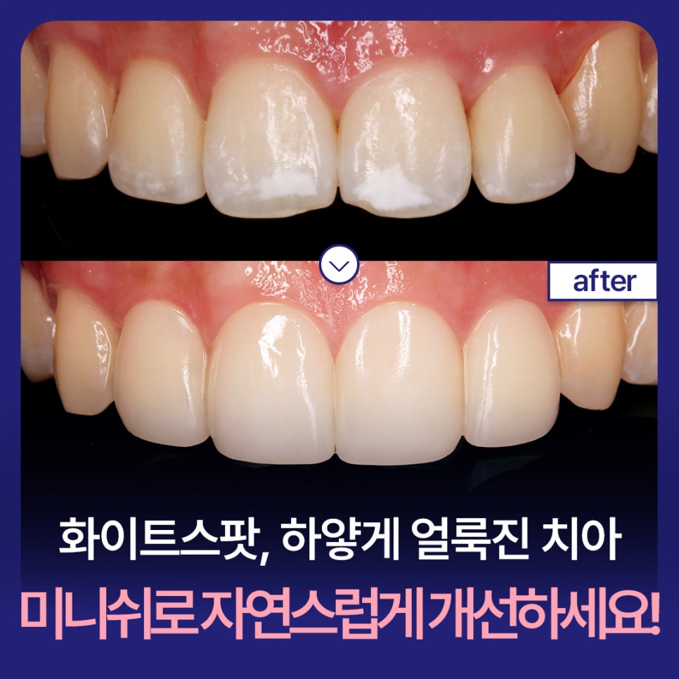 White Spots: Improve Stained Teeth Naturally with Minish! image 1