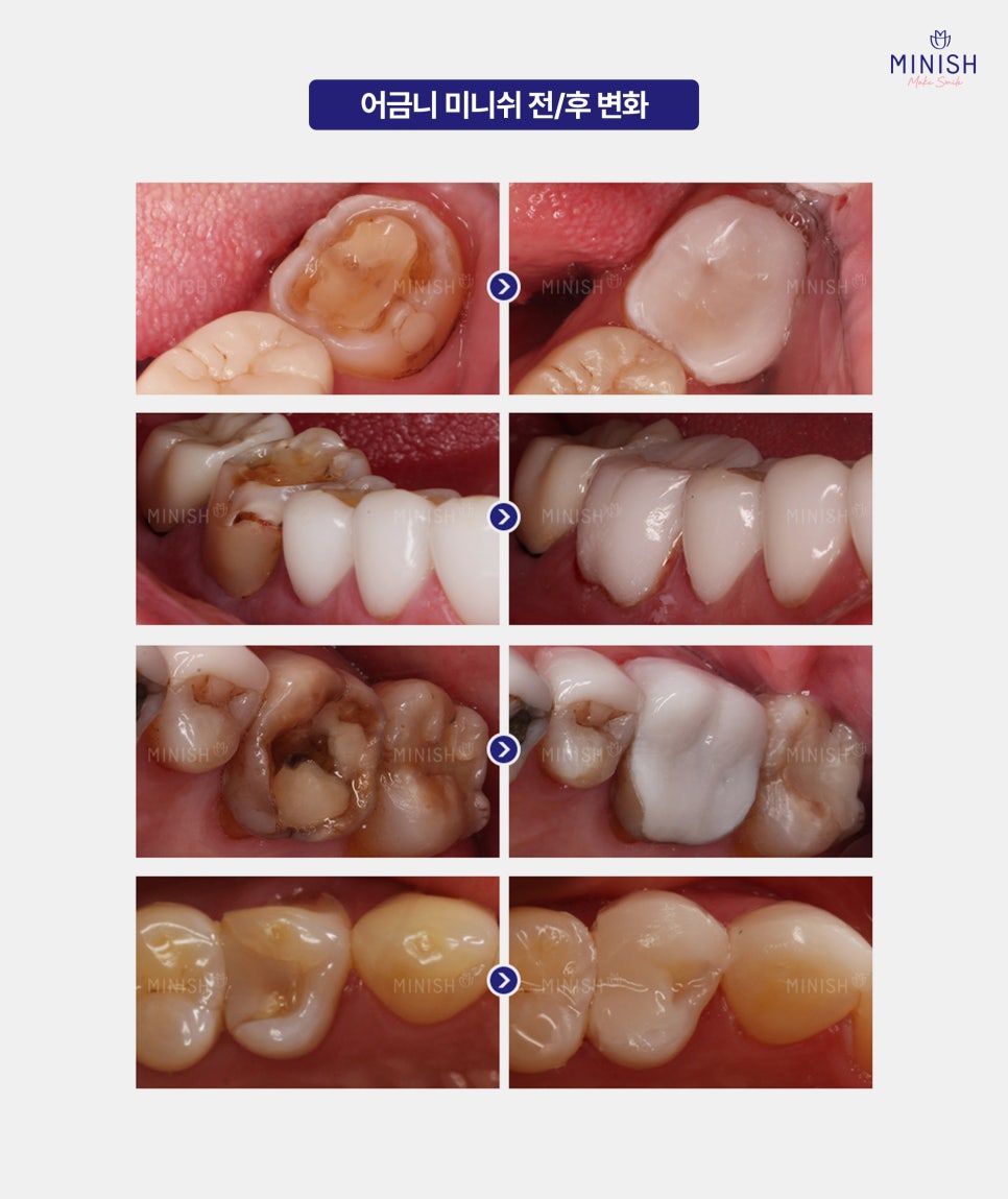 [Cracked Molar] Sudden Pain in Everyday Life, from Causes to Treatment Methods image 6