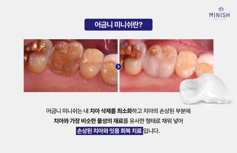 Caused by Cavities? A Complete Guide to Why Molars Break and How to Treat Them image 5