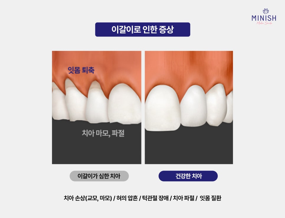 Bruxism and TMJ: If Left Untreated, Both Your Teeth and Joints Could Be at Risk image 3