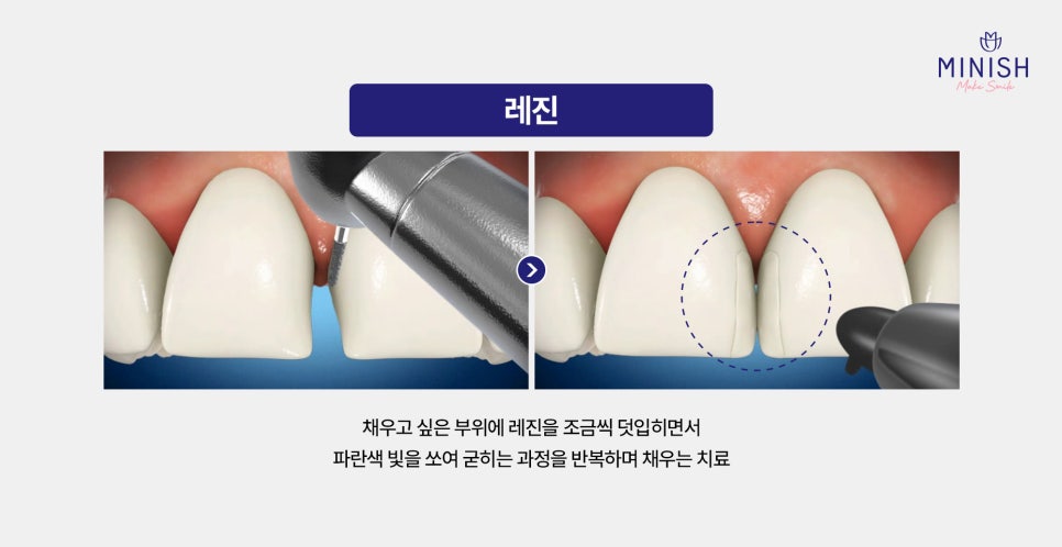 작은치아 왜소치 교정 가장 좋은 방법은? 관련 이미지 3