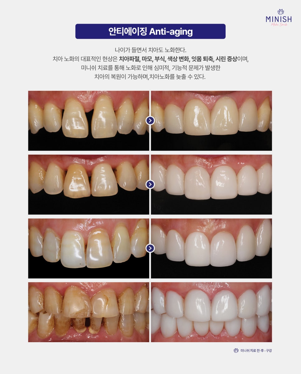 [Tooth Anti-Aging] If your teeth are worn down and sensitive, can Minish help you regain healthy teeth? image 5