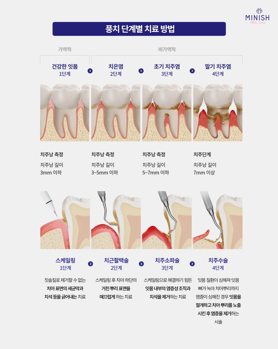 If This Sensitivity Continues, You May Be Developing Periodontal Disease image 4