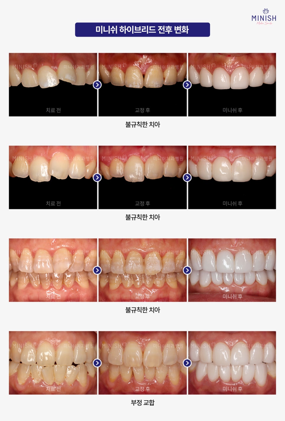 A Complete Guide to the Minish Program That Fits My Teeth image 10