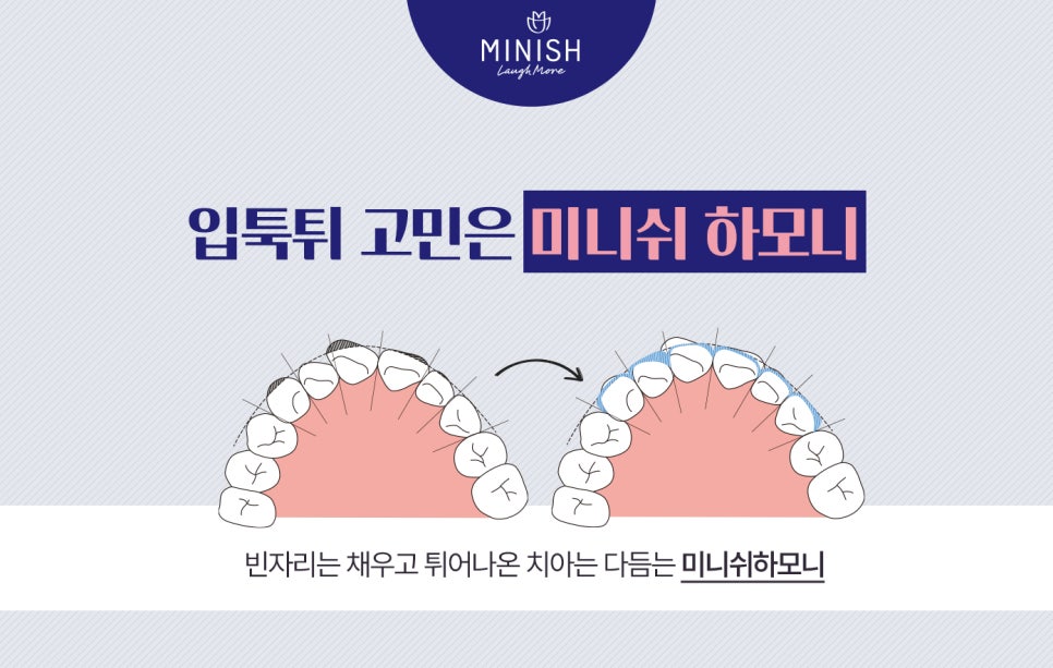 돌출입교정, 빠르게 치아의 비율까지 교정한다? 관련 이미지 2